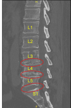 Protuberancia discal y artropatía facetaria
