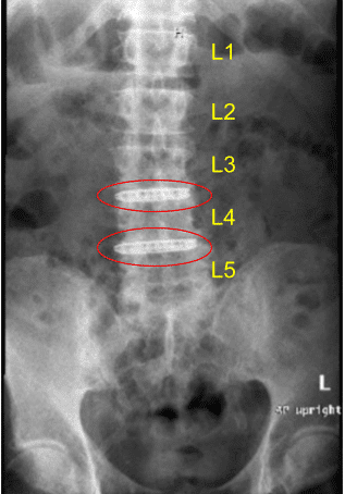 Radiografía postoperatoria