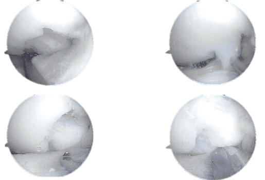 Arthroscopic view tear of the lateral meniscus posterior horn