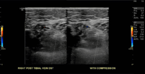 Extremidad Inferior Derecha Venosa Doppler