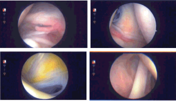Imágenes de artroscopia intraoperatoria