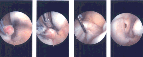 Imágenes de artroscopia intraoperatoria