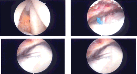Imágenes de artroscopia intraoperatoria