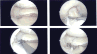 Imágenes de artroscopia intraoperatoria