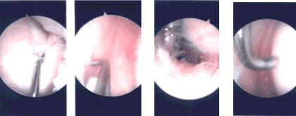 Imágenes de artroscopia intraoperatoria