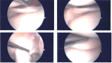 Imágenes de artroscopia intraoperatoria