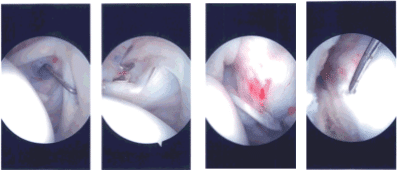 Imágenes de artroscopia intraoperatoria