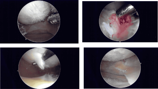 Imágenes de artroscopia intraoperatoria