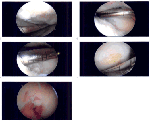 Intraoperative images