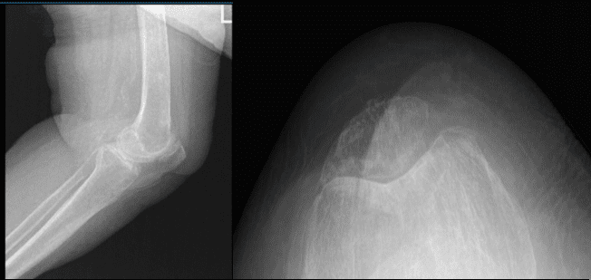 Left Knee X-ray AP and Lateral with Oblique 3 views
