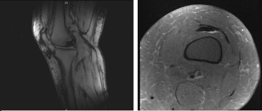 MRI-3T Left Knee Non-contrast