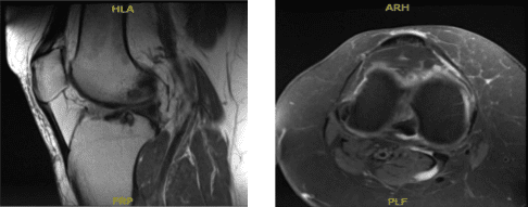 MRI-3T Rodilla Derecha sin contraste