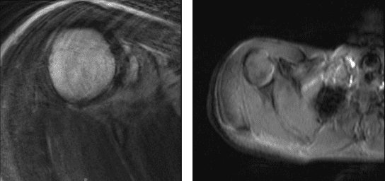 MRI-3T Hombro derecho sin contraste