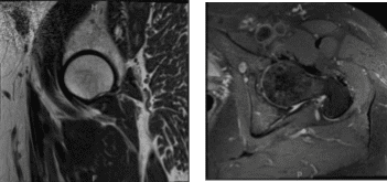 MRI-3T left hip non-contrast