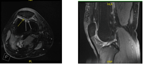Resonancia magnética de rodilla derecha sin contraste