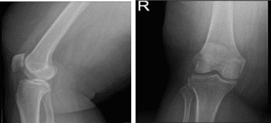 Radiografía de rodilla derecha Lateral y Oblicuo