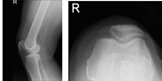 Radiografía de la rodilla derecha AP y Lateral