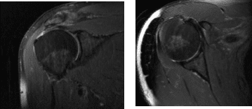 MRI Right Shoulder Non-contrast