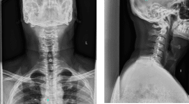 Radiografía: 2 o 3 vistas de la columna cervical