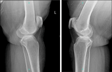 Radiografía completa de la rótula de rodilla izquierda y derecha
