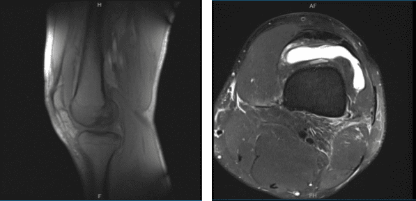 Resonancia magnética de la rodilla izquierda