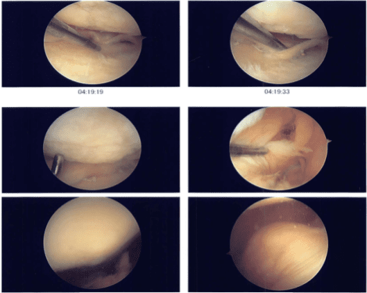 Intraoperative photo