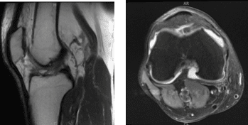 MRI-3T Rodilla derecha sin contraste