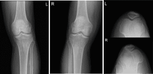 Left and Right knee X-ray complete with patella