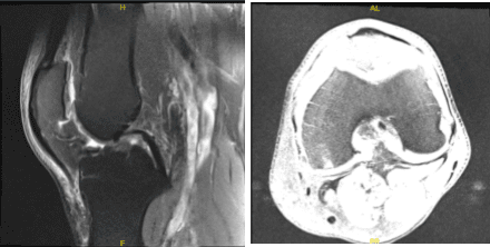 MRI-3T Rodilla izquierda sin contraste