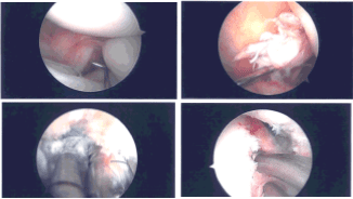 Imágenes de artroscopia intraoperatoria