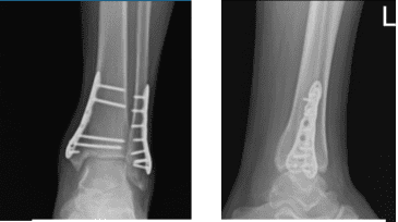 Left Ankle X-ray complete 3 or more views 8 weeks post operative Left Ankle X-ray complete 3 or more views 8 weeks post operative