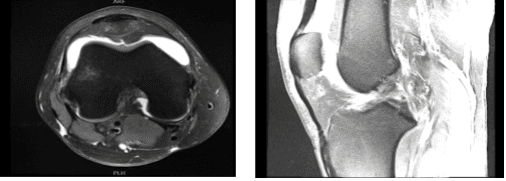 MRI-3T Rodilla derecha sin contraste