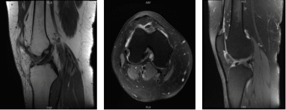 MRI-3T Rodilla derecha sin contraste
