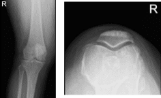MRI-3T right knee non-contrast