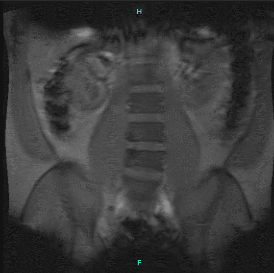 Resonancia magnética de columna lumbar sin contraste