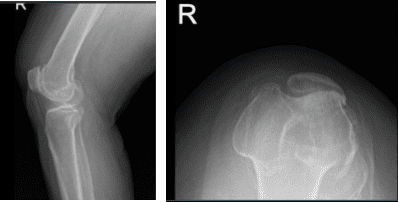 MRI of right knee