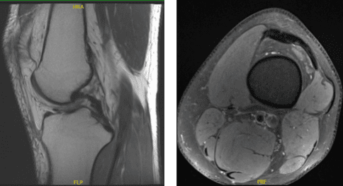 Resonancia magnética de la columna vertebral posterior