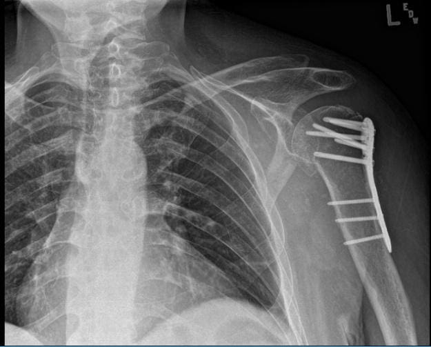 Radiografía postoperatoria