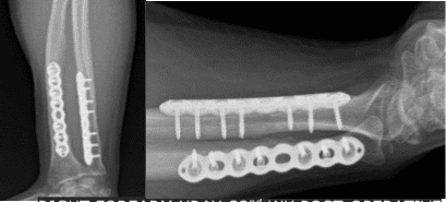 Right Forearm X-ray-32nd week post-operative