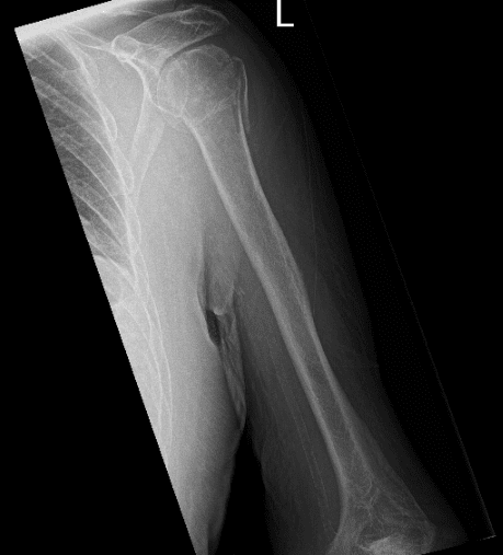 Radiografía del hombro izquierdo