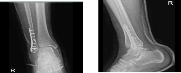 Radiografía del tobillo derecho - 2 semanas después de la cirugía