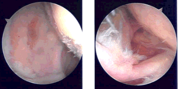 Imágenes intraoperatorias Imágenes intraoperatorias
