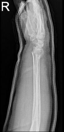 Radiografía del codo derecho