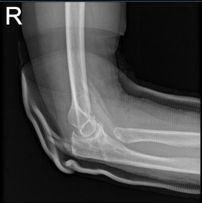 Bilateral de la extremidad inferior venosa Doppler