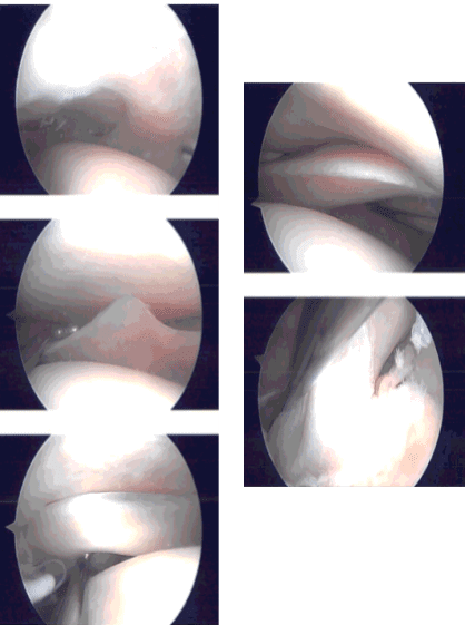 Imágenes de artroscopia intraoperatoria