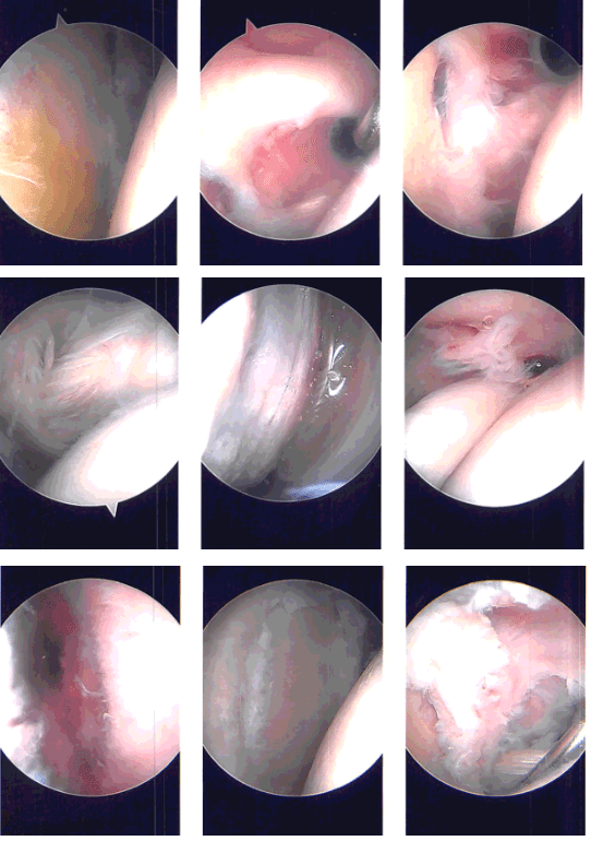 Imágenes de artroscopia intraoperatoria