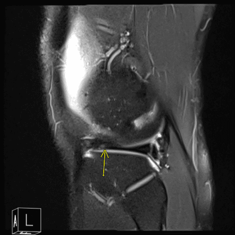 Resonancia magnética de rodilla izquierda